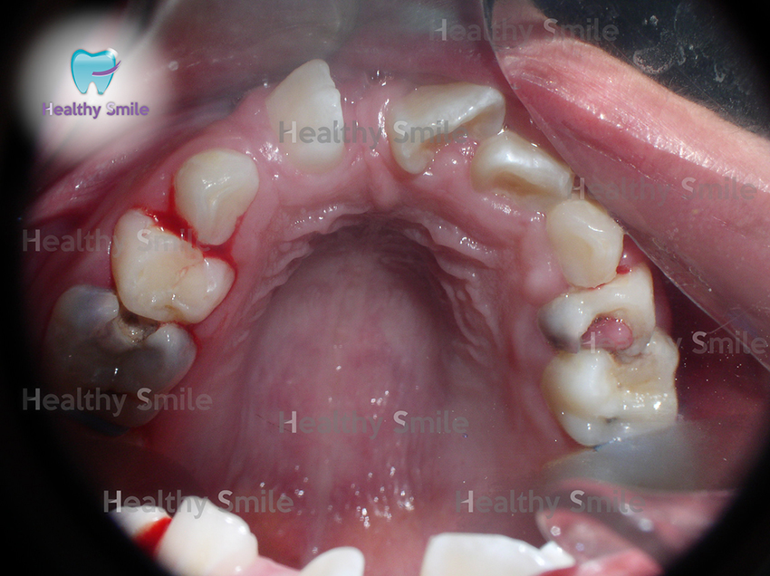 Antes
